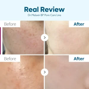 کرم ضد لک ترانگزامیک اسید دکتر ملاکسین